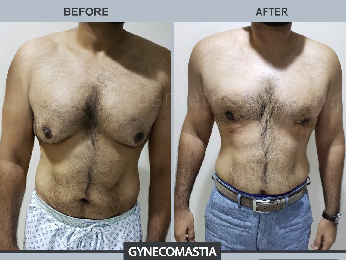 Gynecomsatia Before After Cosmetic Surgeon