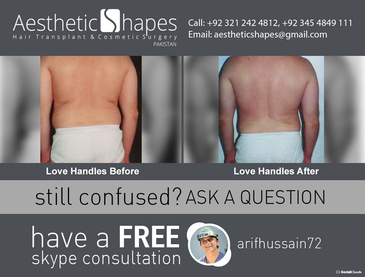 Liposuction of the 'love handles' or flanks