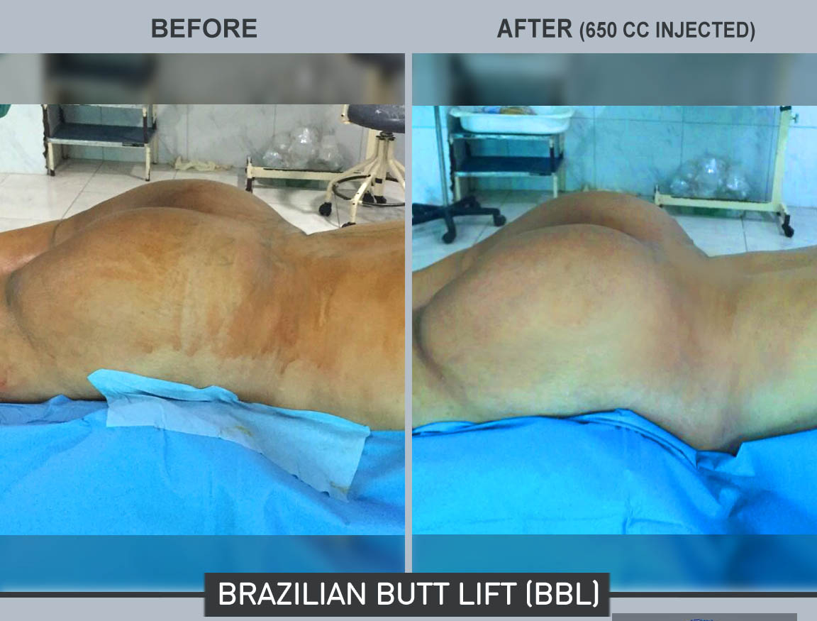 How does a Brazillian Butt Lift work?