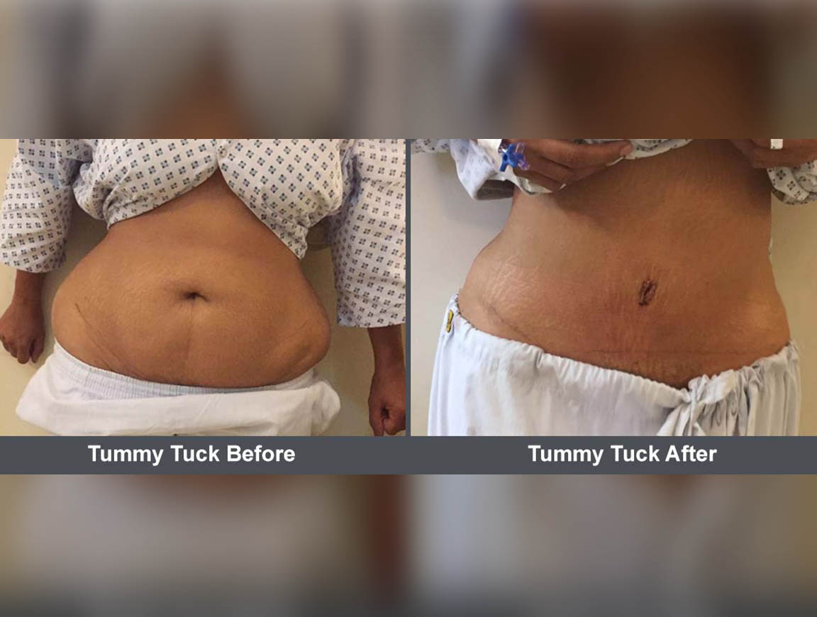 Tummy Tuck Before amp After Results Cosmetic Surgeon
