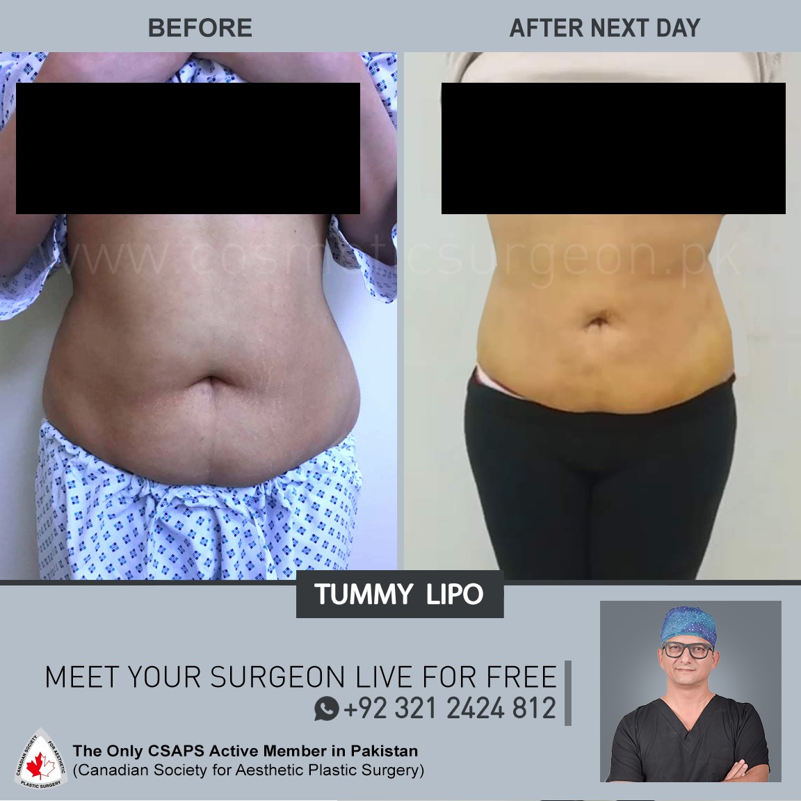 360 lipo and tummy tuck miami