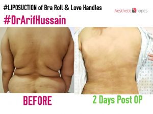 Bra Roll Back Liposuction, before and after treatment, Bra Roll Back Liposuction Treatment in Pakistan