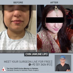 chin jawline liposuction, before and after surgery, jawline liposuction in Pakistan