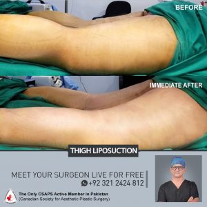Thigh liposuction Karachi, Thigh Fat removal treatment, Thigh liposuction in Pakistan