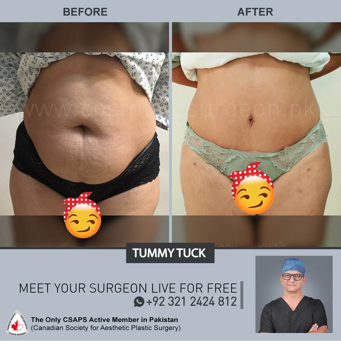 Before After Tummy Tuck w Lipo 360