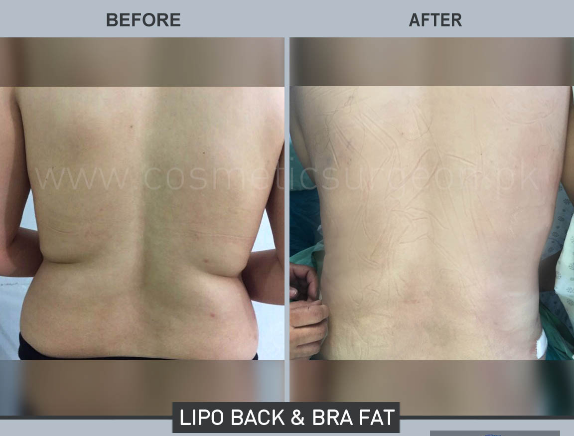 https://cosmeticsurgeon.com.pk/wp-content/uploads/2019/01/back-bra-fat-liposuction-karachi-pakistan.jpg