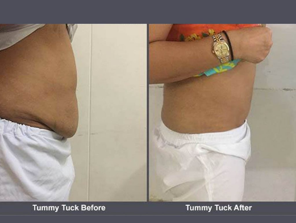 items yoy need before and after tummy tuck surgery