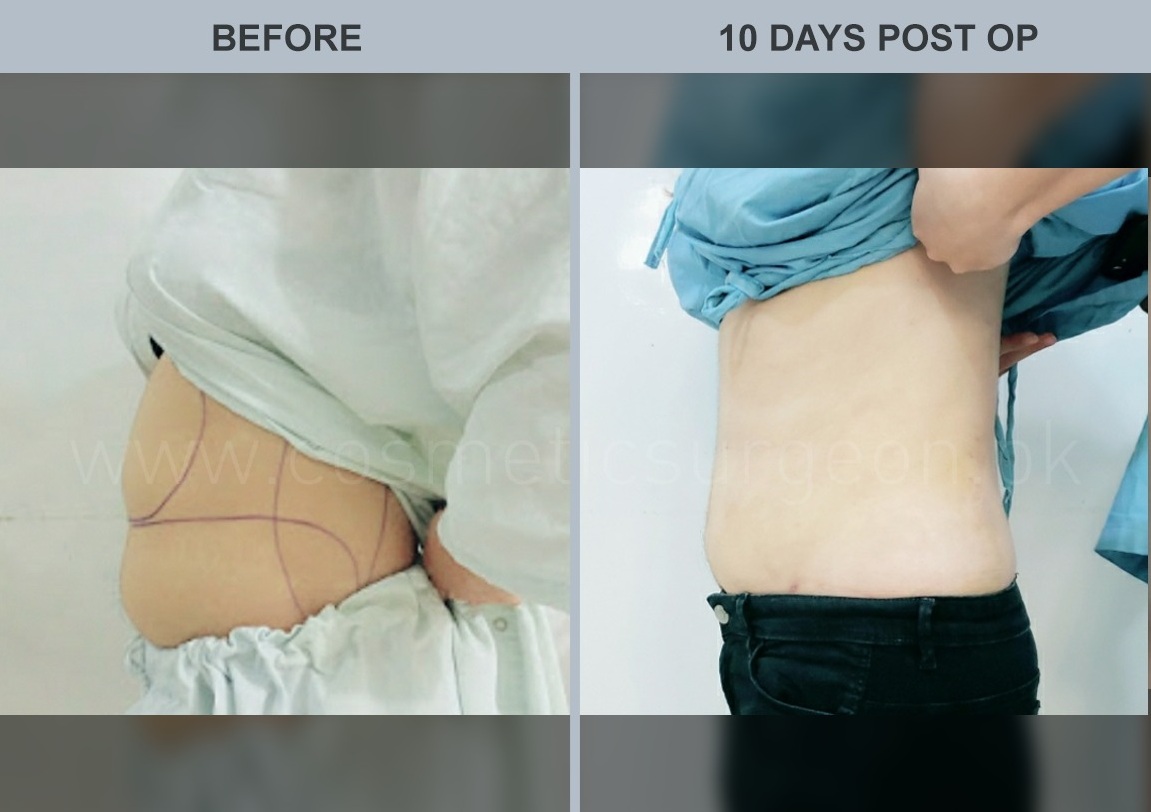 liposuction and tummy tuck recovery time