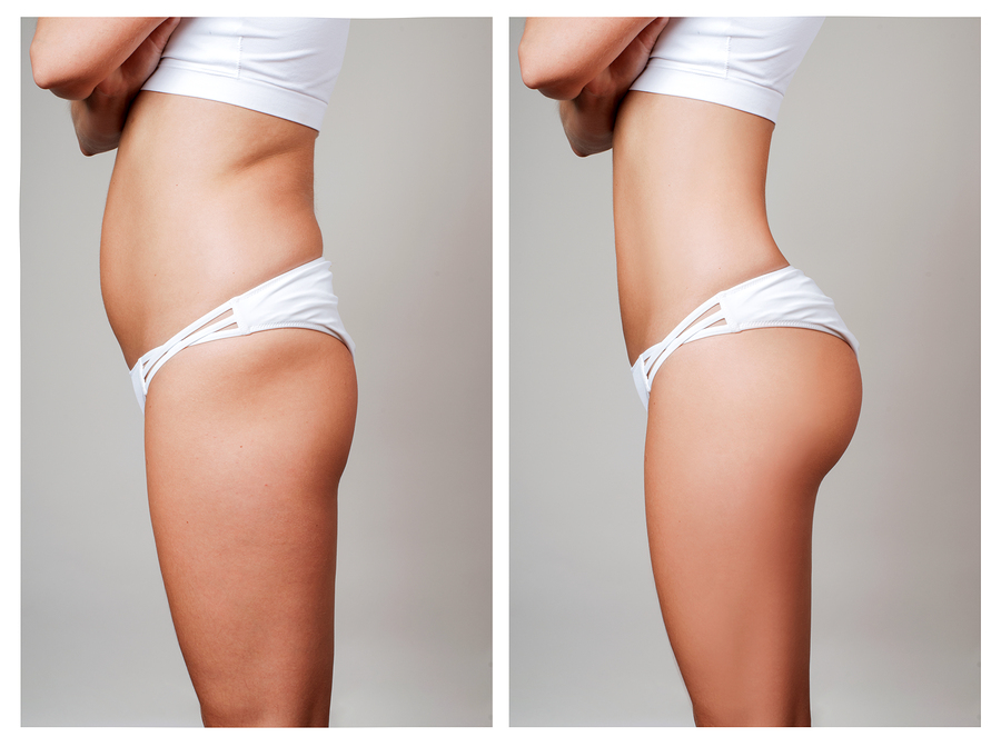 How Long Does a Brazilian Butt Lift Last? - Cosmetic Surgeon