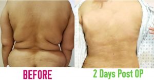 Bra Roll Back Liposuction, before and after OP, Bra Roll Back Liposuction Services in Lahore