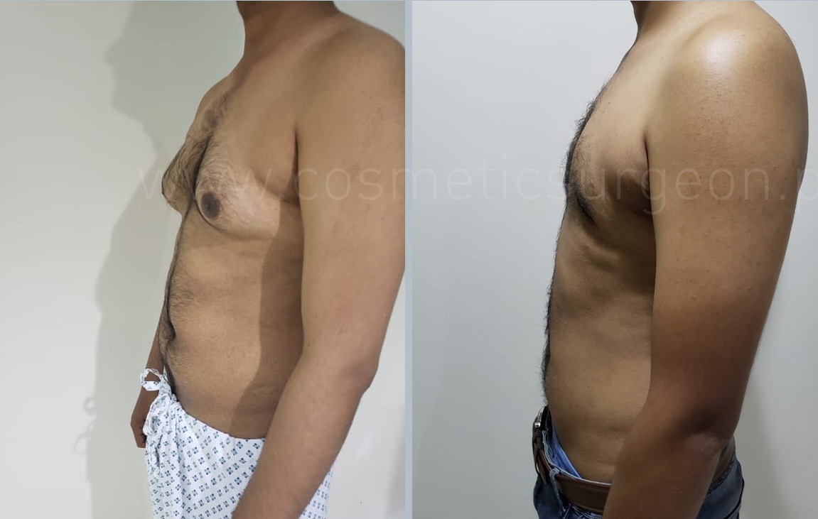 Post Op Surgery Gynecomastia Lipo Slim