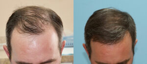 Hair Transplant