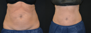 hanging Belly After Child Birth