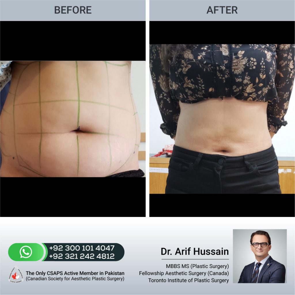Liposuction before and after front,