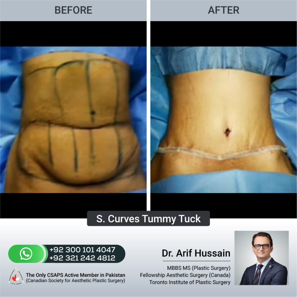 Abdominoplasty: Enhancing Confidence and Health