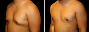 gynecomastia before and after