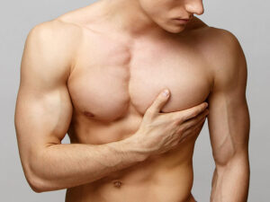 gynecomastia