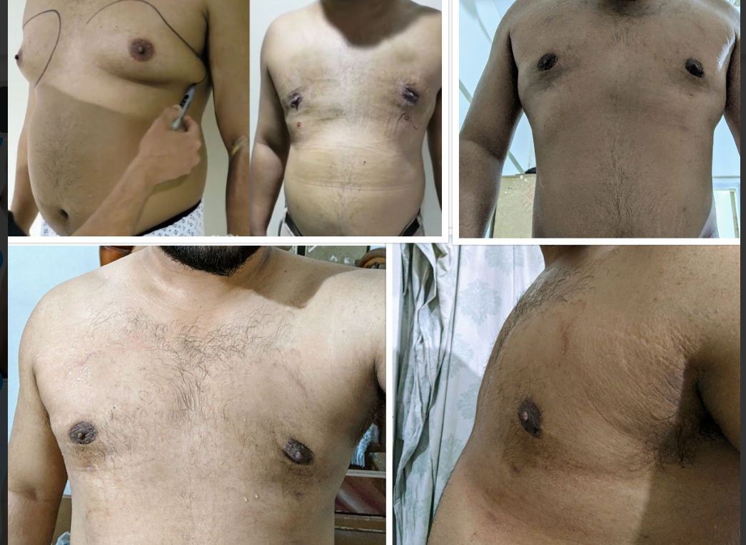 Can Gynecomastia Be Treated With Creams Or Surgery Is A Must