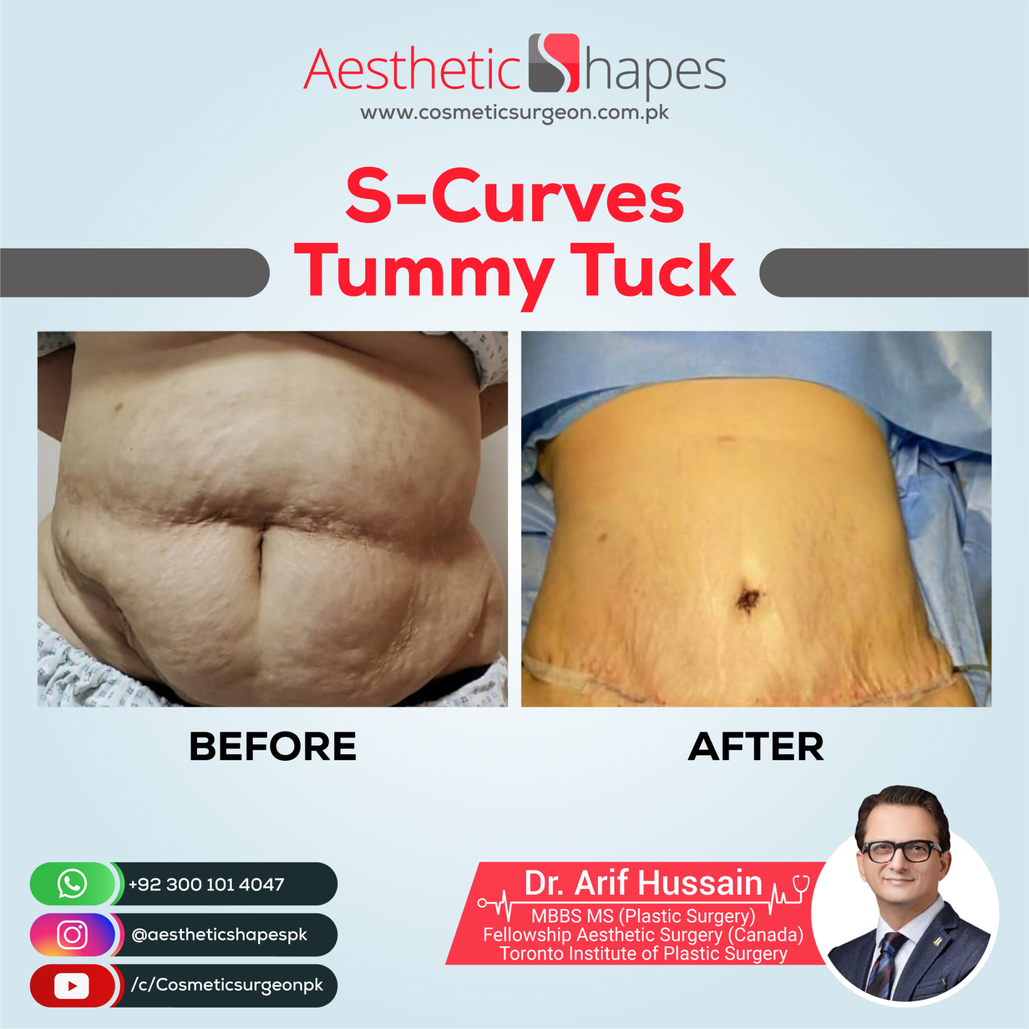 https://cosmeticsurgeon.com.pk/wp-content/uploads/2022/02/s-curves-tummy-tuck-facebook-page-dr-arif-hussain-scaled.jpg