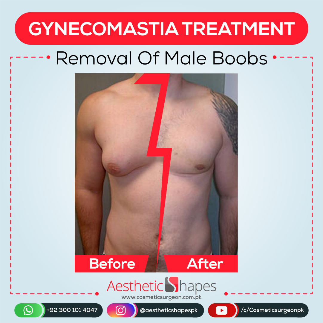 How To Get Rid Of Puffy Nipples Or Type 1 Gynecomastia?