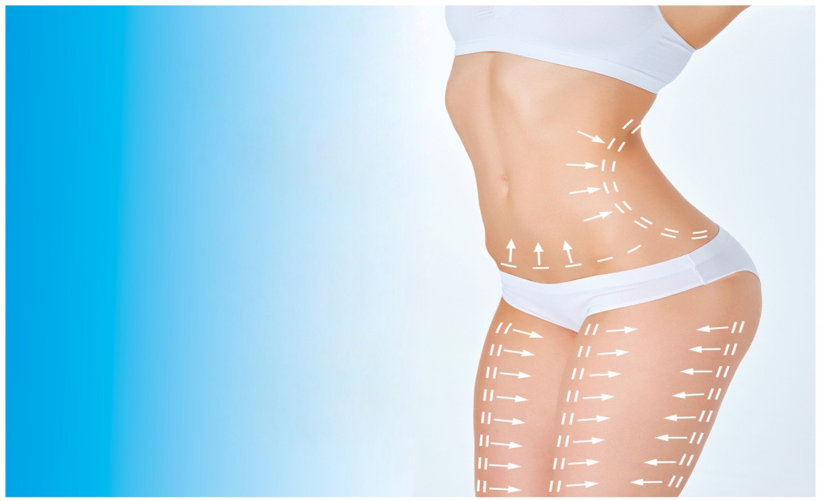 Tummy tuck with lipo on the flanks can create the hourglass shape -  Hourglass Tummy Tuck