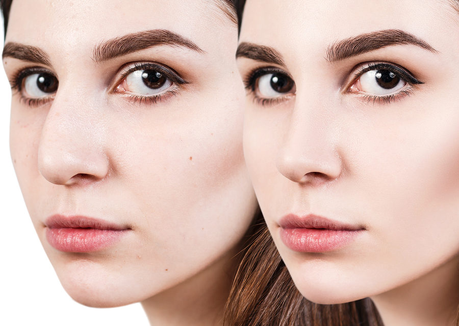 rhinoplasty myths and facts