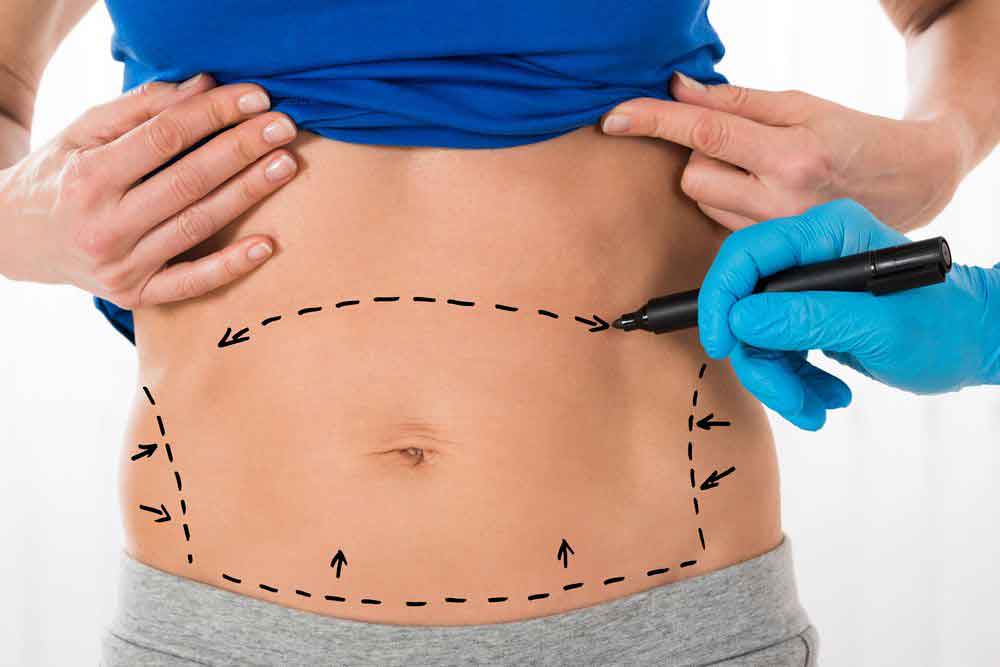 liposuction surgery in karachi