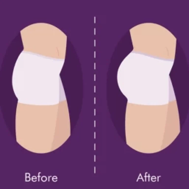 Butt-Implants4_1717577033_medium