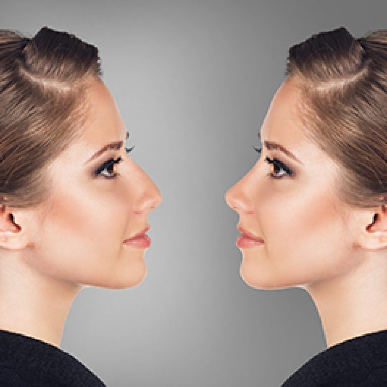 Nose-Reshaping-1