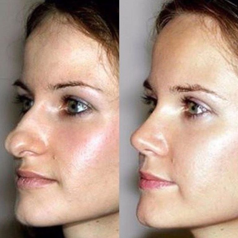 Nose Reshaping Surgery