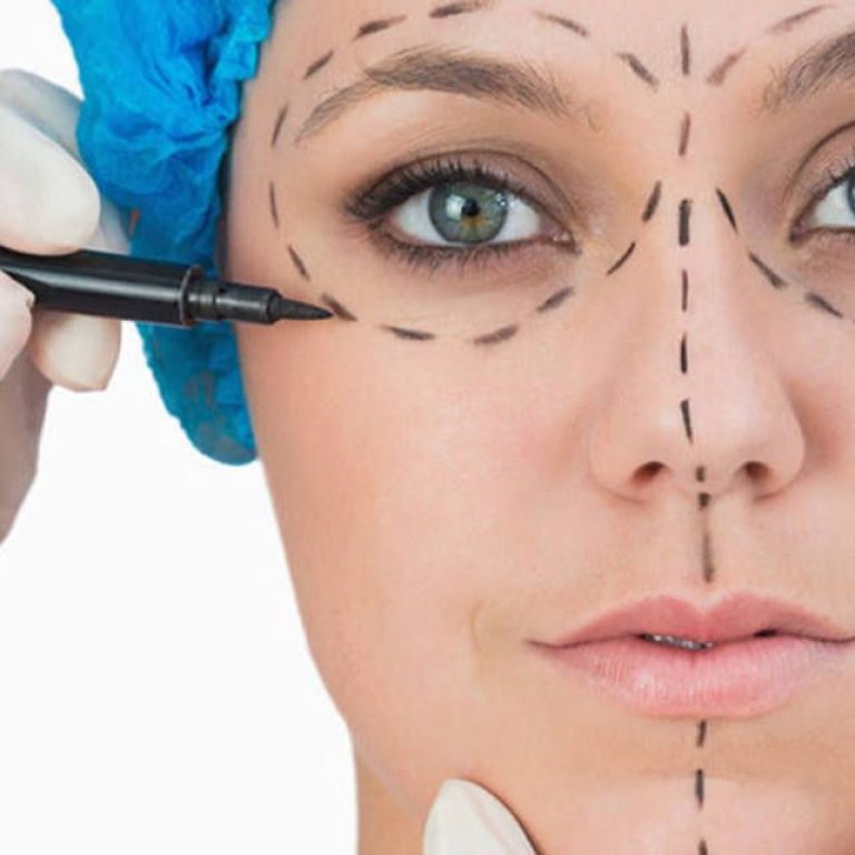 Surgical Facelift With Fat Grafting, face lift, doctor marking the face