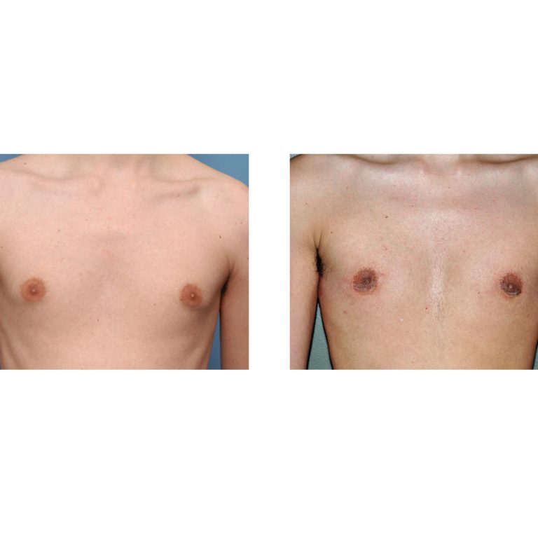 areolar-gynecomastia-surgery-dr-barry-eppley-indianapolis1