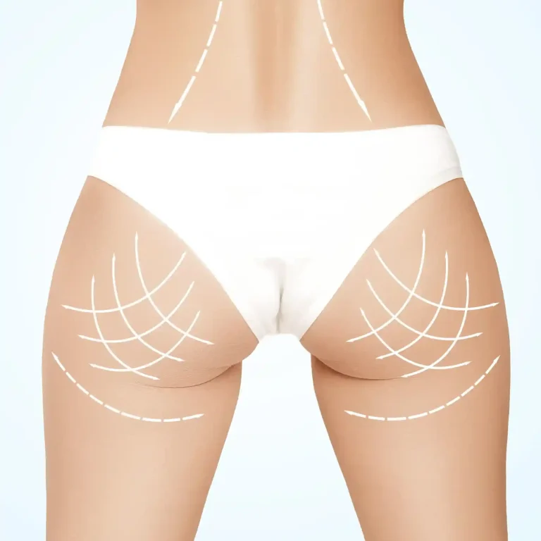 brazilian-butt-lift