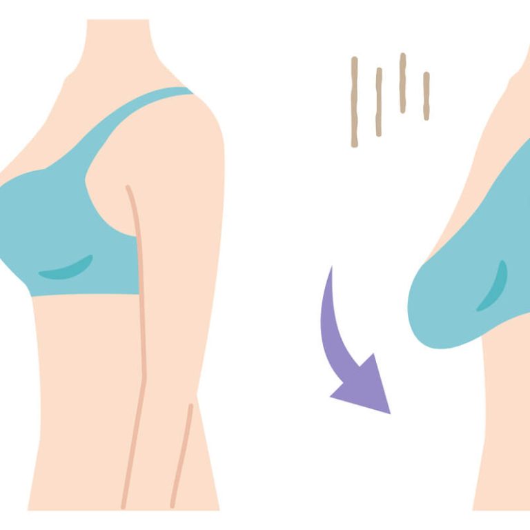 Breast lift