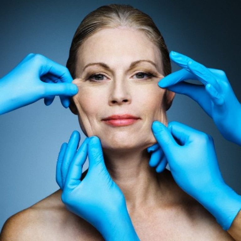 facelift