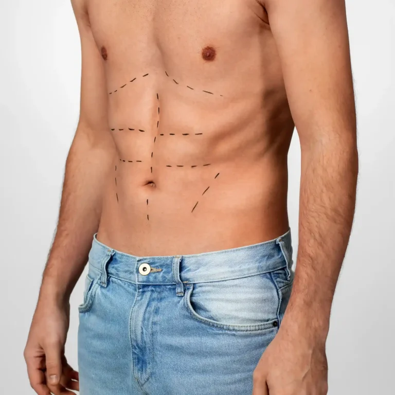 gynecomastia