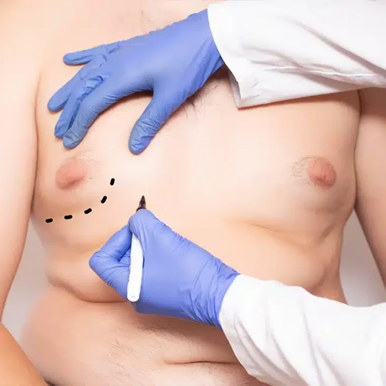 liposuction-or-sculpsure-for-gynecomastia