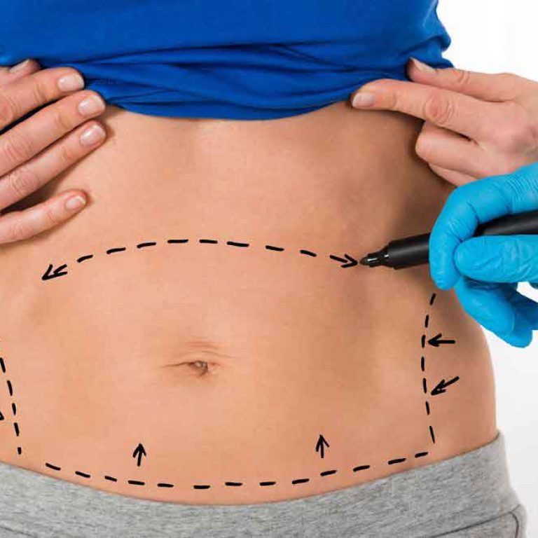liposuction-surgery