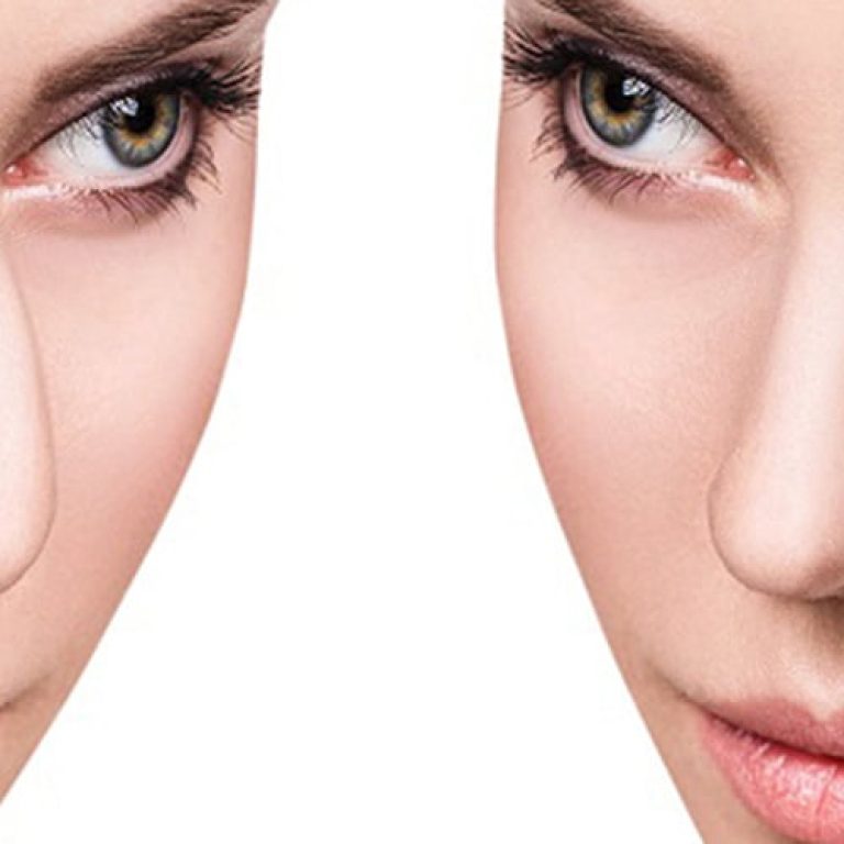 rhinoplasty-1