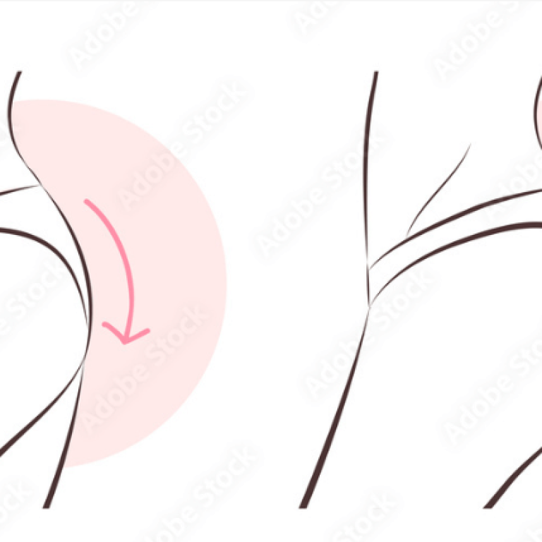 brazilian butt lift