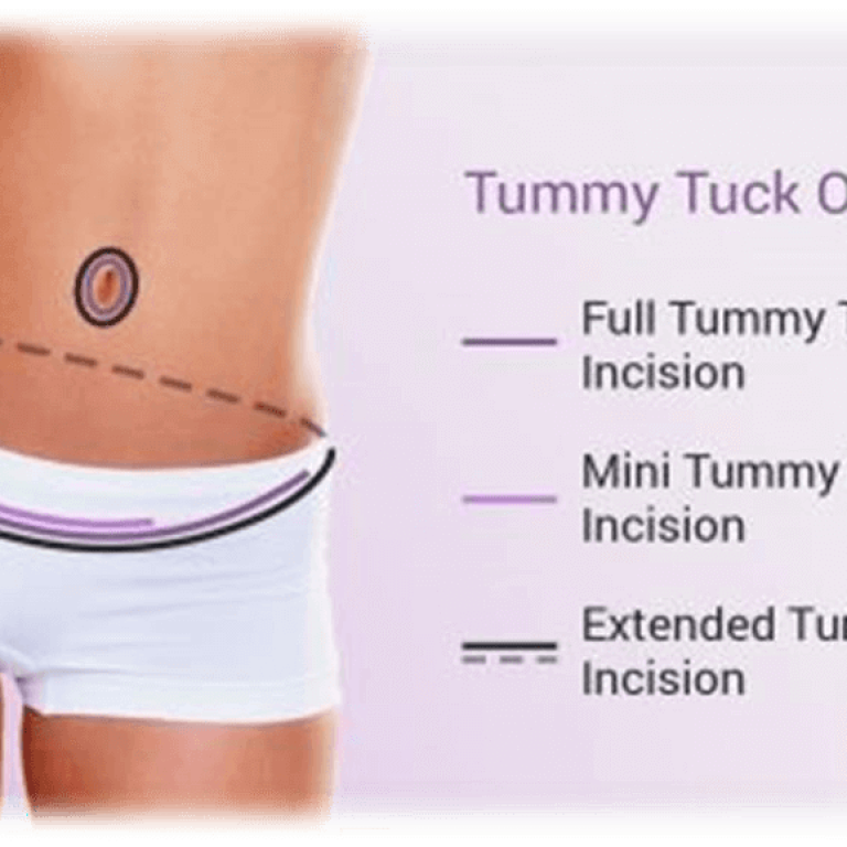 tummy tuck 4