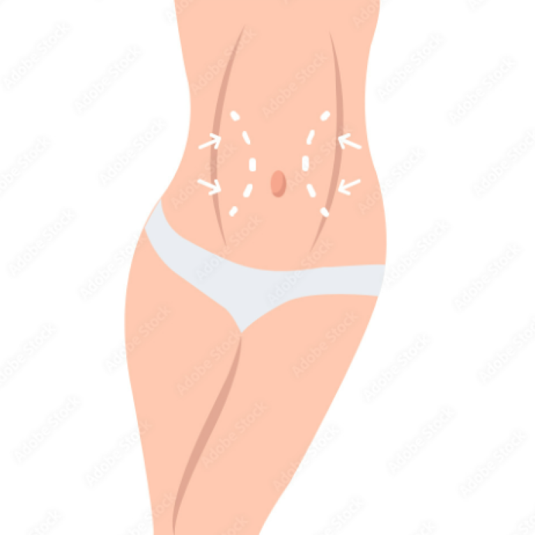 Tummy Tuck